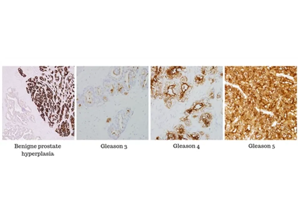 Psma Expression In Different Gradations Klein NRG