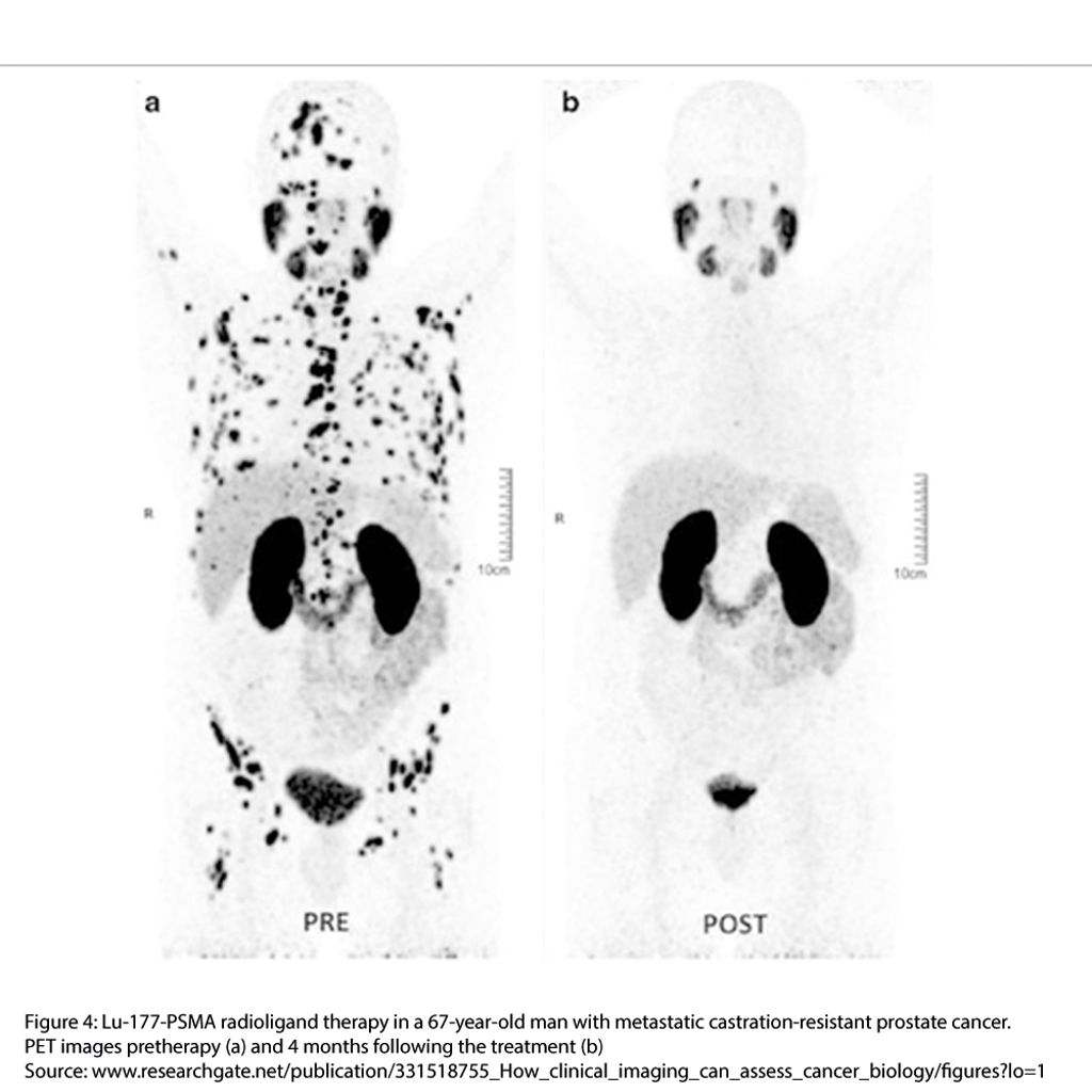 Lu 177 PSMA Radioligand Therapy Medical Isotopes