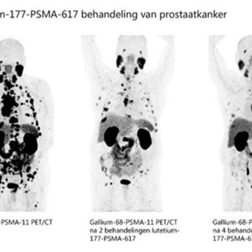 Lutetium 177 Uitgezaaide Prostaat Kanker