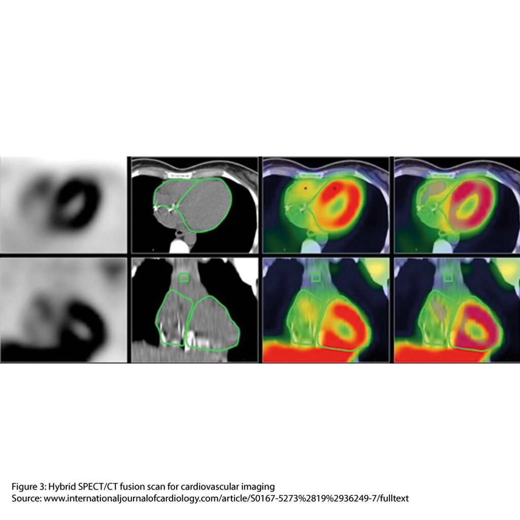 Hybrid SPECT CT Fusion Scan For Cardiovascular Imaging Medical Isotopes