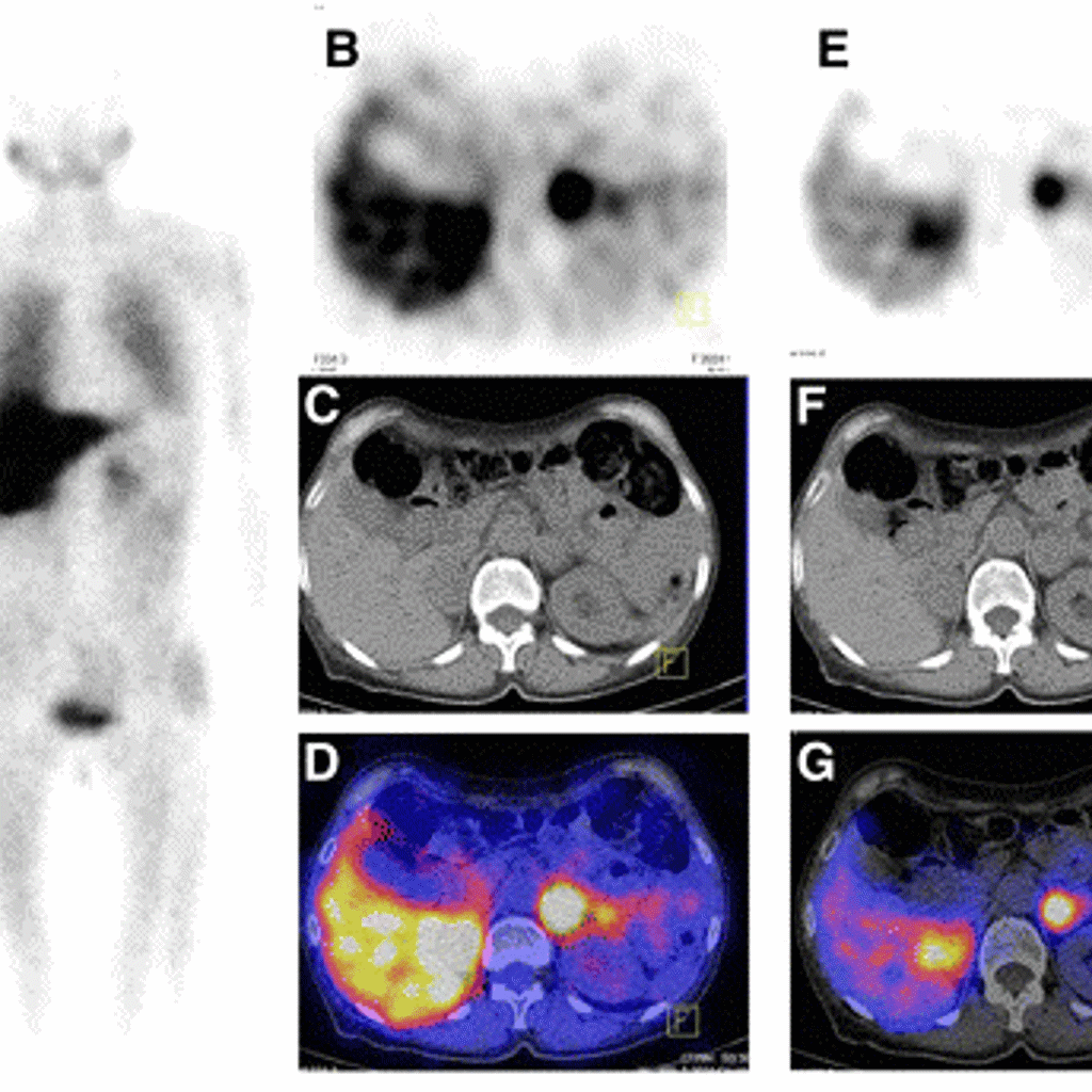 SPECT CT Scan Image Voorbeeld Www.Curiumpharma.Com Nl Producten